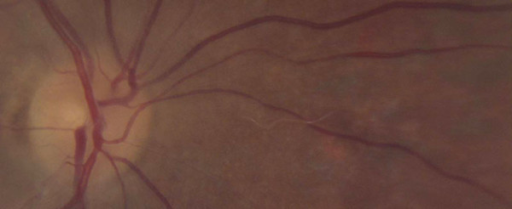 Retinal fundus image showing a nematode larva, likely Baylisascaris procyonis, in a patient’s eye