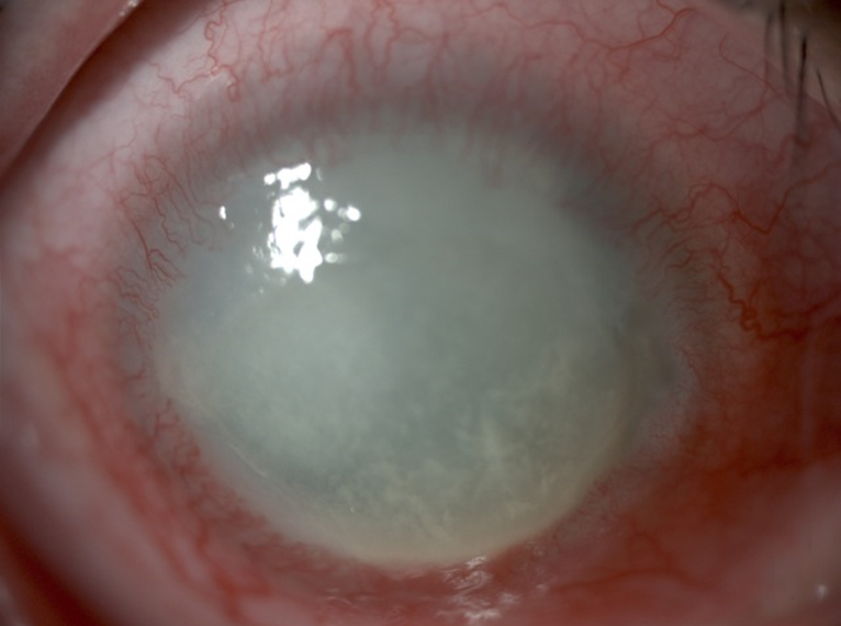 Corneal melting and vascularization in a patient with Acanthamoeba keratitis