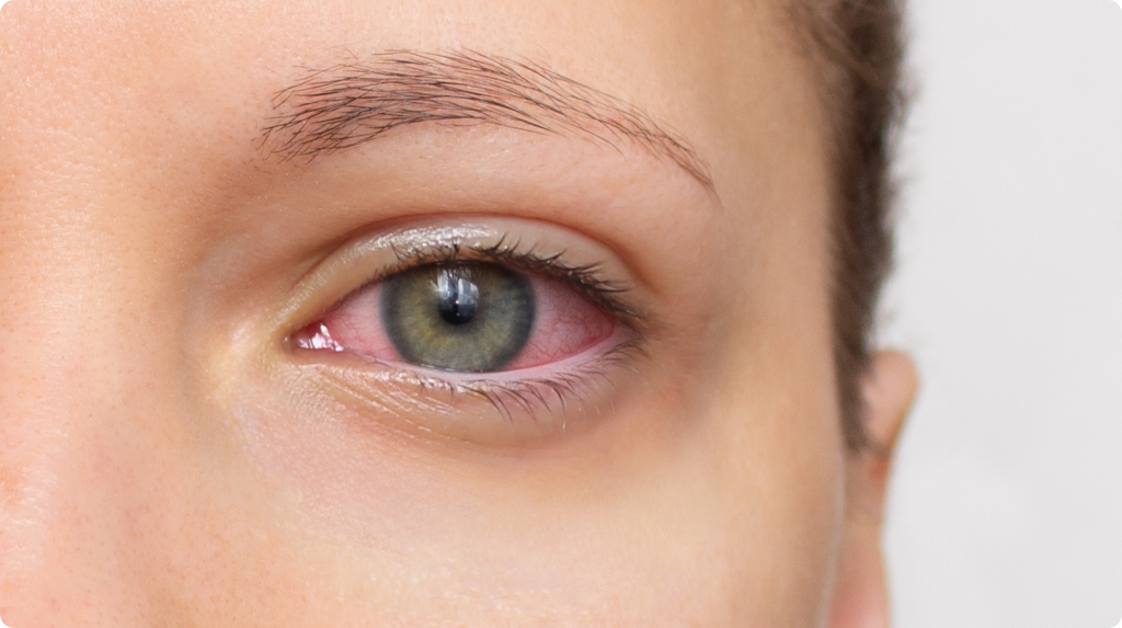 Close-up of an eye with a red, irritated sclera to show eye redness and inflammation.
